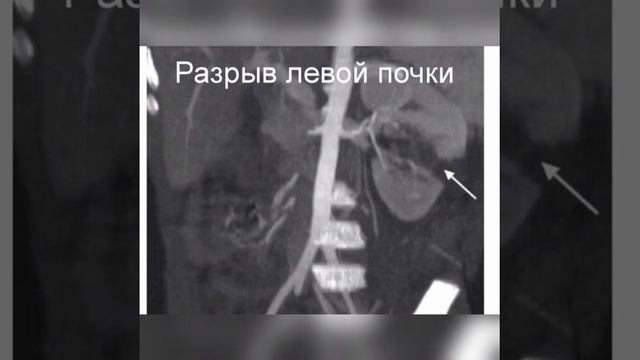 ТРАВМЫ ПОЧЕК И МОЧЕВОГО ПУЗЫРЯ смотреть онлайн