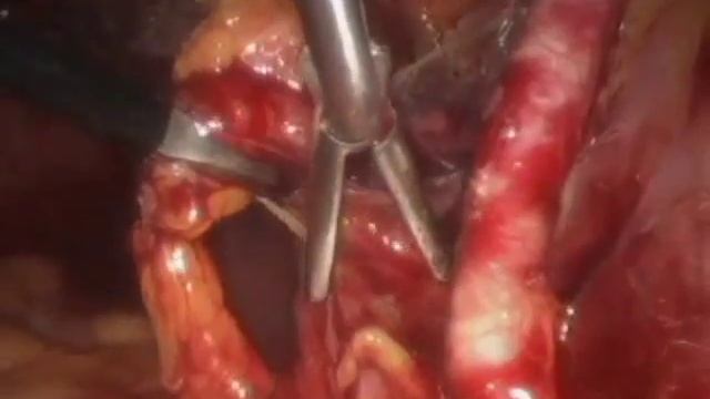 Lymph Node Dissection Right Pelvic Laparoscopic 882 смотреть онлайн