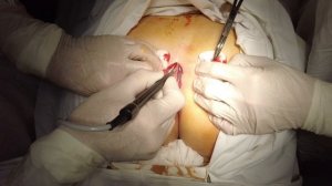 Киста копчика. Простая болезнь, простое лечение