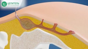 Киста копчика! Как вылечить.