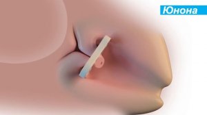 Введение акушерского пессария Юнона (Симург)