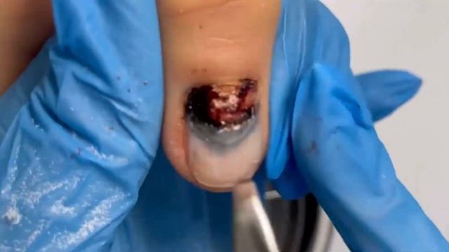 Как зачистить ГЕМАТОМУ??⚠️❗️ смотреть онлайн