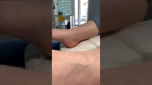 Грибок ногтей - Подолог