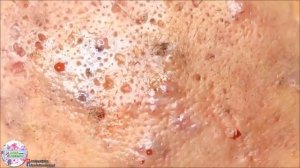 БОЛЬШИЕ УГРИ ПРЫЩИ ДАВЛЮ! Как избавиться от прыщей ЧЕРНЫХ ТОЧЕК