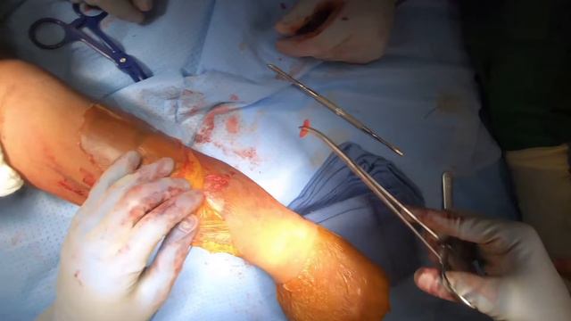 Both bone forearm fracture open reduction internal fixation - Dr. Lee смотреть онлайн
