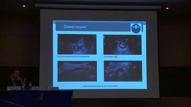 Бирюкова Ю.А. — Возможности УЗИ при остром дивертикулите