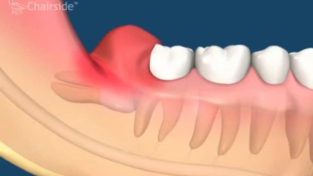 Перикоронарит смотреть онлайн