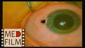 Рак глаза, удаление © Еye cancer, removal