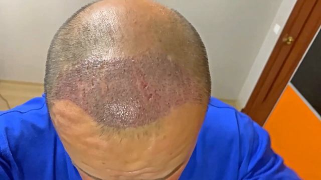 Снятие корочек с пересаженных волос в домашних условиях | 10 дней после трансплантации волос смотреть онлайн