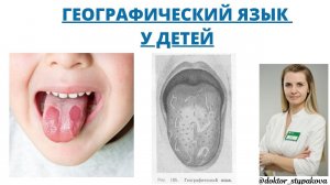 Географический язык. О каких заболеваниях свидетельствует данное состояние. Десквамативный глоссит.