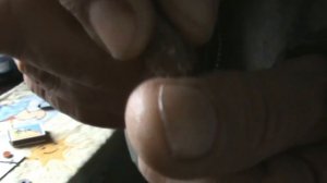 Отит и Су Джок