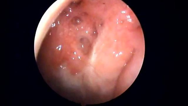 Nasal Septum Mobility. Подвижность (флотация) перегородки носа.