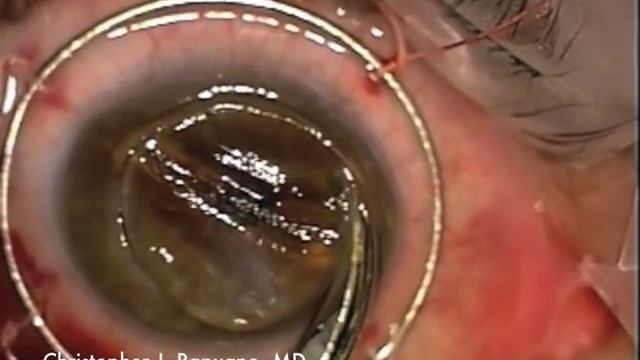 Penetrating Keratoplasty (PK) for Post LASIK Ectasia and Hydrops смотреть онлайн