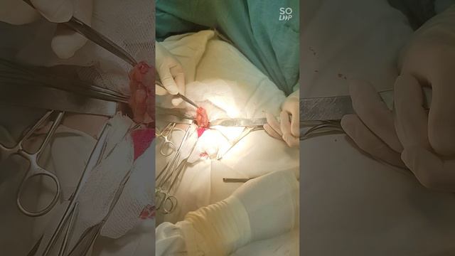 ЭКСТРЕННАЯ операция АППЕНДЭКТОМИЯ - флегмонозный АППЕНДИЦИТ