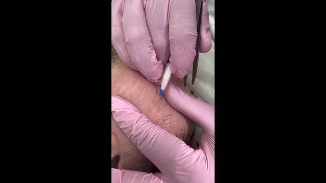 Долгий путь к решению проблемы Электроэпиляция смотреть онлайн