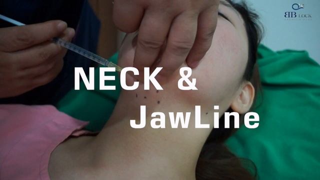 BB Lock Thread Lifting ( FACE / Nasolabial Fold / Double Chin )