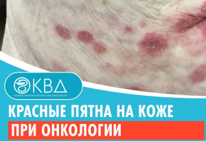 ? Красные пятна на коже при онкологии. Клинический случай №787