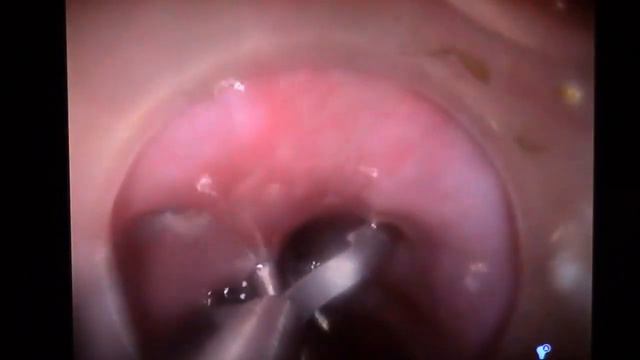 Endoscop Часть 11 смотреть онлайн