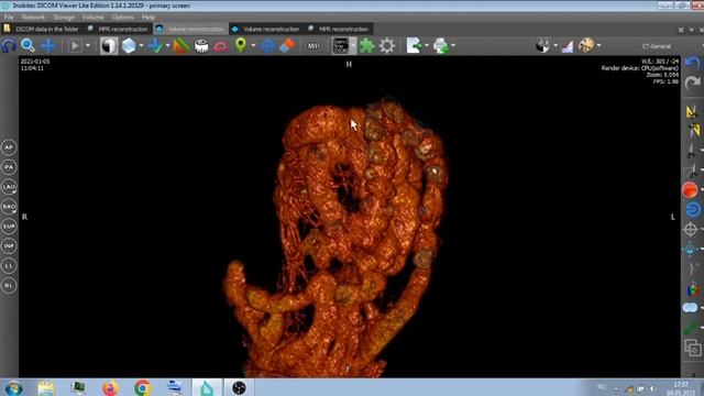 ГРЫЖА ТРЕЙТЦА НА КТ БРЮШНОЙ ПОЛОСТИ , БЕЗ КОНТРАСТА . смотреть онлайн