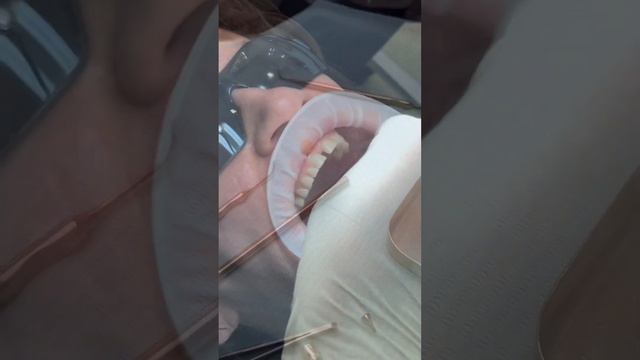 Снятие слепков для изготовления коронок смотреть онлайн