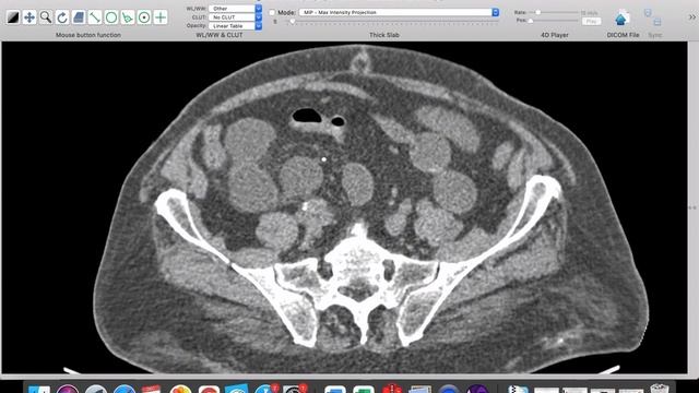 | GIT | IO | Trans-mesenteric internal hernia | смотреть онлайн