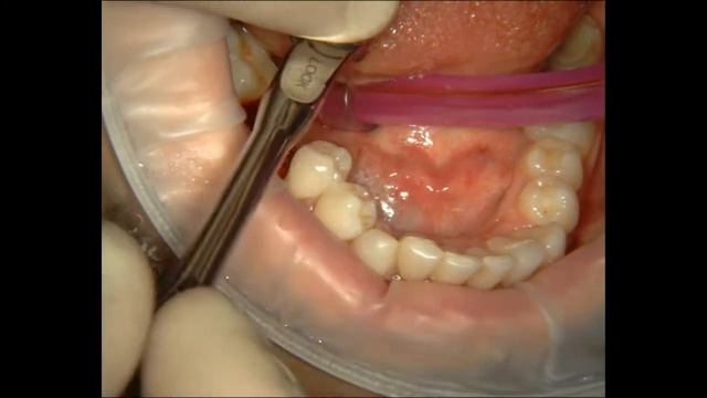 Расщепление альвеолярного гребня в обл.46 и имплантация. смотреть онлайн