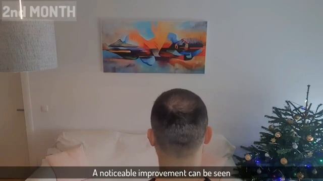 Minoxidil & Dermarolling Results 6 MONTHS | Month By Month Progress