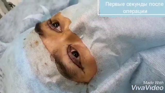 Птоз верхних век. Dr.BIGELDIYEV RB CLINIC 8 702 747 11 77 смотреть онлайн