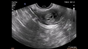 Гиперплазия эндометрия в менопаузе