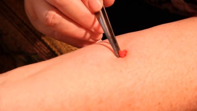 Как правильно вытащить клеща в домашних условиях у человека смотреть онлайн