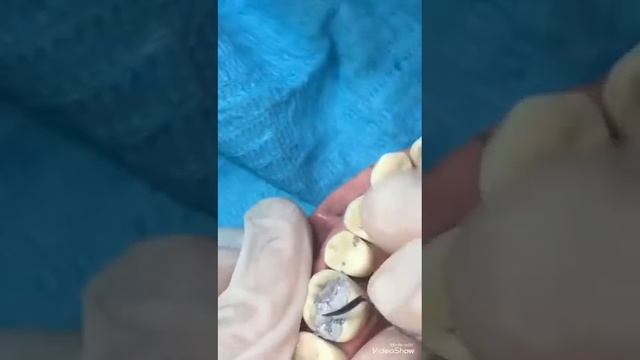 Class 2 OD amalgam restoration for upper first molar смотреть онлайн