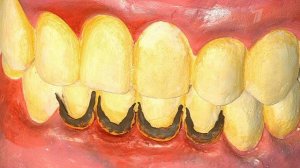 Жить здорово! Выпуск от 24.06.2013