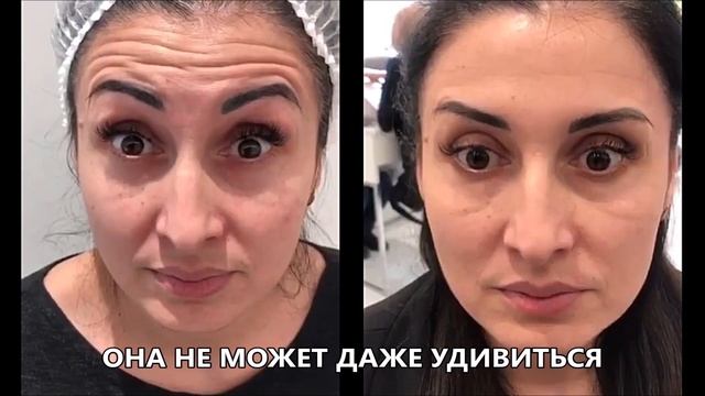 ❗️ОСТОРОЖНО! ?БОТОКС лишает эмоций и искажает лицо! смотреть онлайн