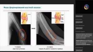 Лекция. Аппарат Илизарова. сращение перелома.