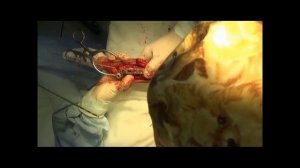 Перелом предплечья пластина с угловой стабильностью