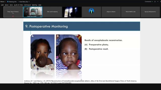 Jumat Ilmiah - Encephalocele Reconstruction смотреть онлайн