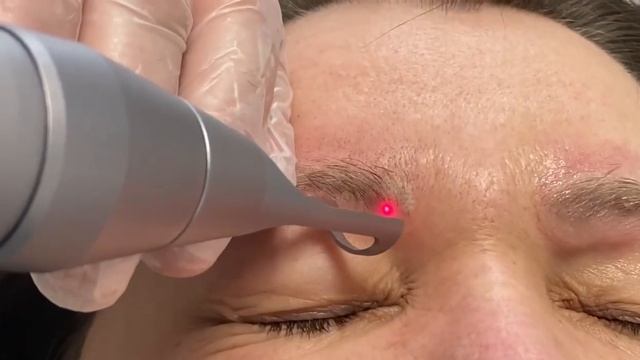 Удаление татуажа лазером сверх короткого импульса и охлаждение