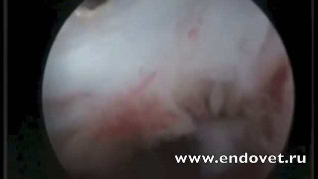 Резекция медиального мениска