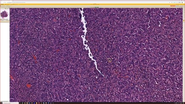 Skin Metastases & Mimics: Rapid Board Review for Dermatology Pathology Dermpath (18 Classic Cases) смотреть онлайн