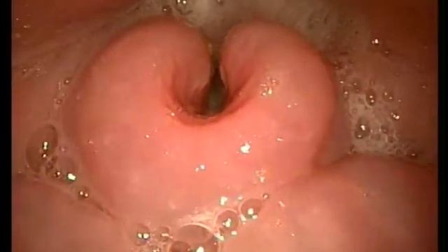 Pre bronchoscopy endoscopic exam in a patient after radiation therapy from AOD pt1425 смотреть онлайн