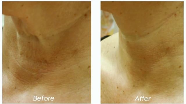 Лазерное омоложение Clear Lift на аппарате Alma Lasers в сети клиник МедЛайн смотреть онлайн