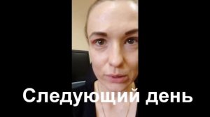 Показательная процедуры на аппарате Pelsar до и после