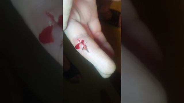 Как снять хирургический шов ч1 смотреть онлайн