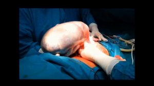 Удаление огромной кисты яичника