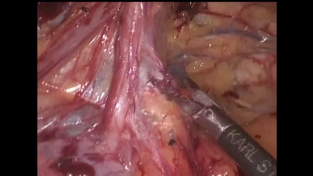 TAPP (Трансабдоминальная предперитонеальная пластика) слева