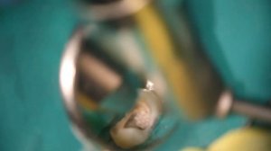 Постановка стекловолоконного штифта + композитный Build-up