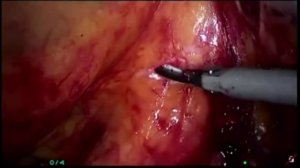 Резекция сигмовидной кишки (российская бригада хирургов)