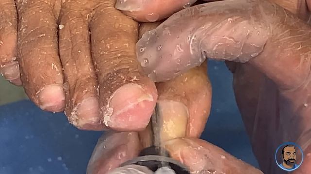 Trimming and Shaping Long Overdue for clipping Toenails (90 year old Needing Help with her Toenails смотреть онлайн