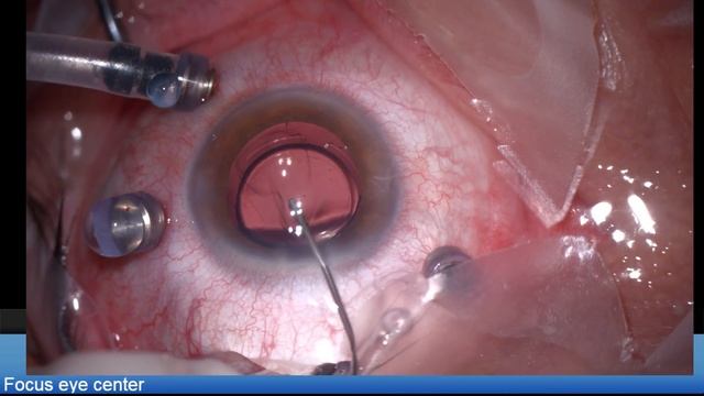 Post myopic PRK eye, LENTIS Comfort EDOF , macular hole Lukan Mishev Live Stream смотреть онлайн