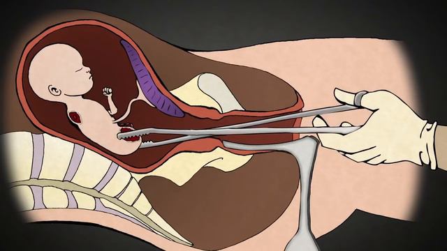The Horror of 2nd Trimester Surgical Abortion смотреть онлайн